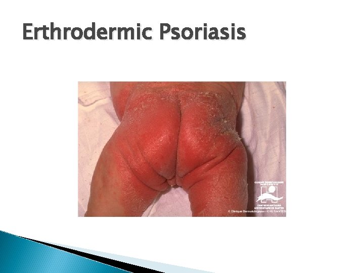 Erthrodermic Psoriasis 