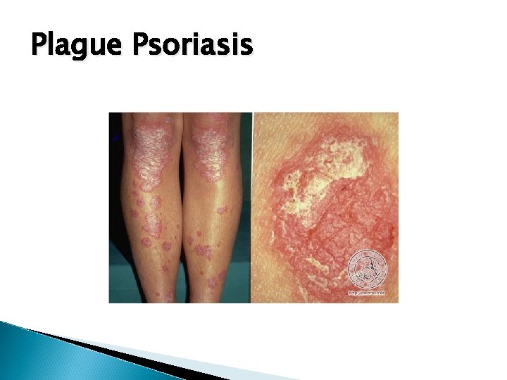 Plague Psoriasis 