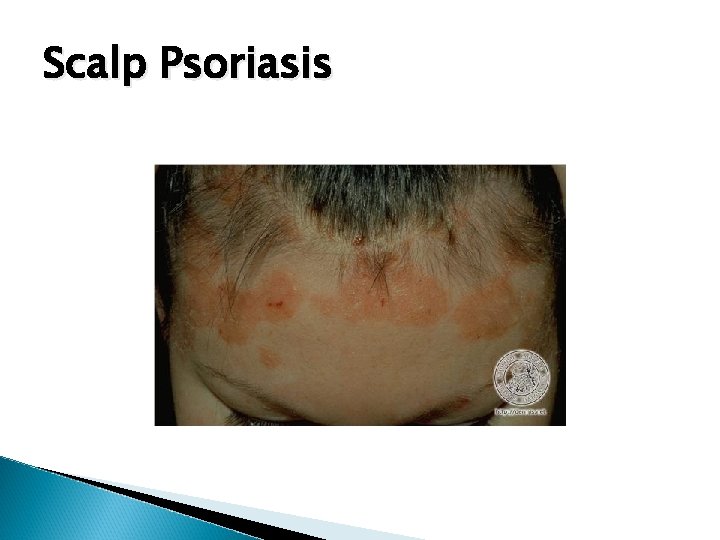Scalp Psoriasis 