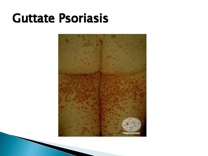 Guttate Psoriasis 