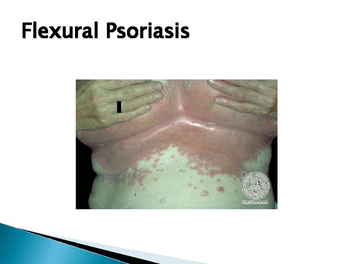 Flexural Psoriasis 