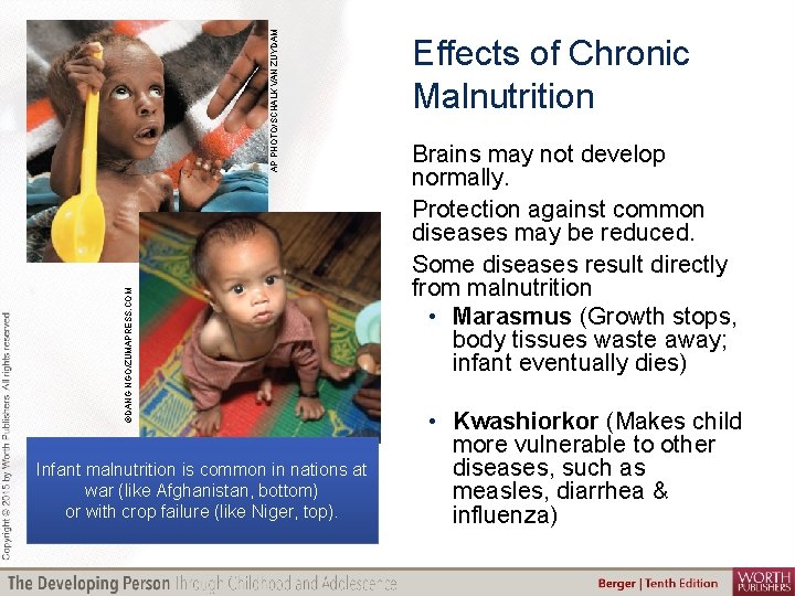 AP PHOTO/SCHALK VAN ZUYDAM ©DANG NGO/ZUMAPRESS. COM Infant malnutrition is common in nations at