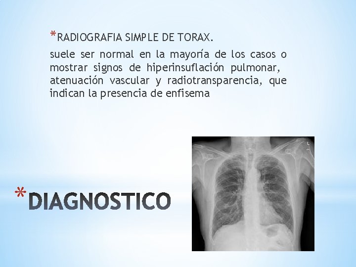 *RADIOGRAFIA SIMPLE DE TORAX. suele ser normal en la mayoría de los casos o