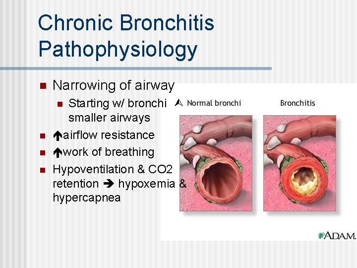 Chronic Bronchitis Pathophysiology n Narrowing of airway Starting w/ bronchi smaller airways airflow resistance
