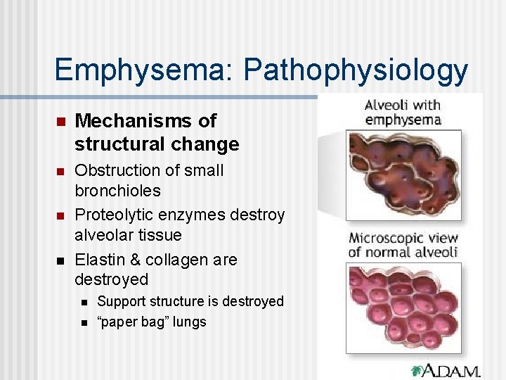 Emphysema: Pathophysiology n Mechanisms of structural change n Obstruction of small bronchioles Proteolytic enzymes