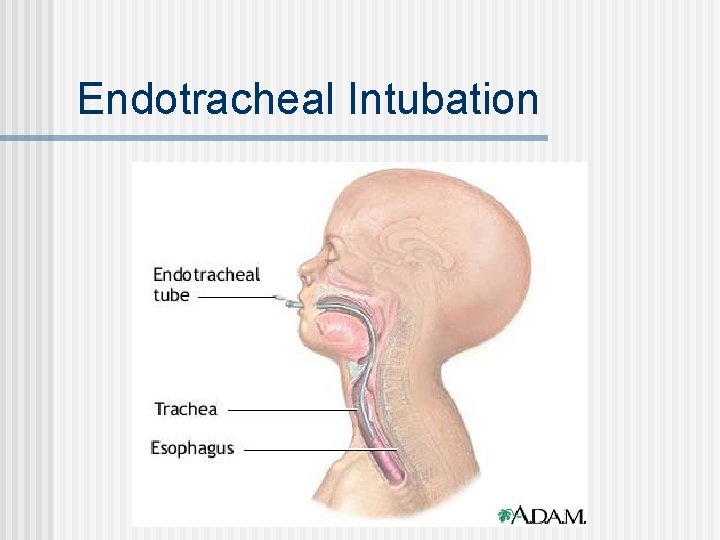 Endotracheal Intubation 