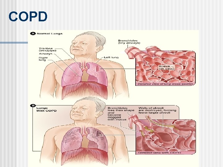 COPD 