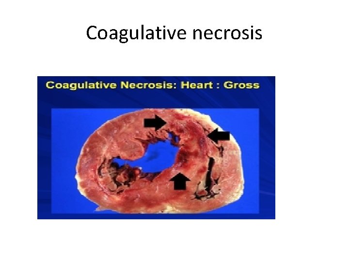 Coagulative necrosis 