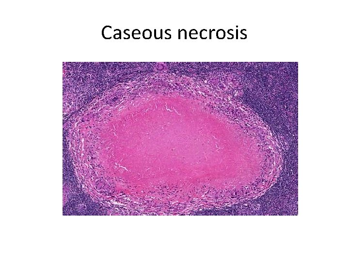 Caseous necrosis 