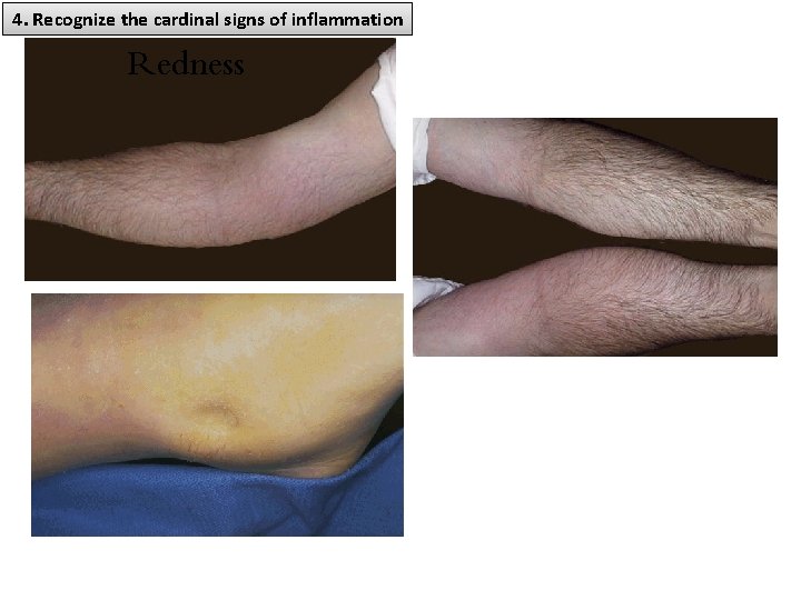 4. Recognize the cardinal signs of inflammation Redness 