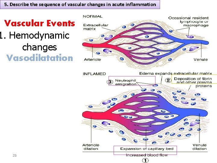 5. Describe the sequence of vascular changes in acute inflammation Vascular Events 1. Hemodynamic