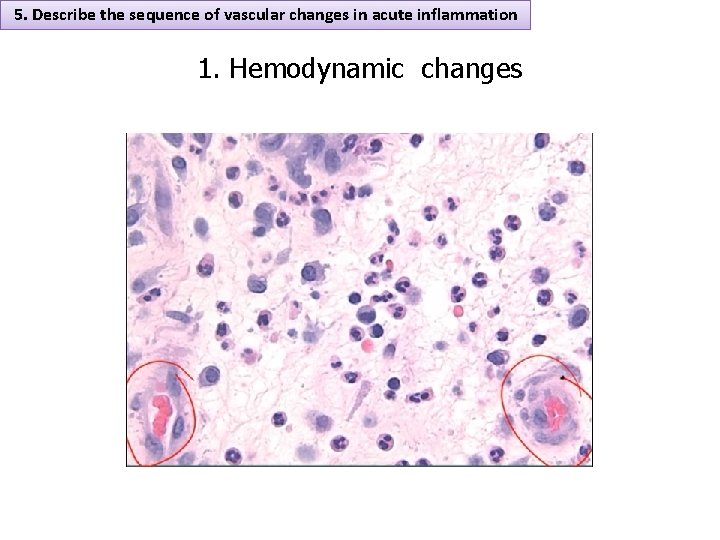 5. Describe the sequence of vascular changes in acute inflammation 1. Hemodynamic changes 