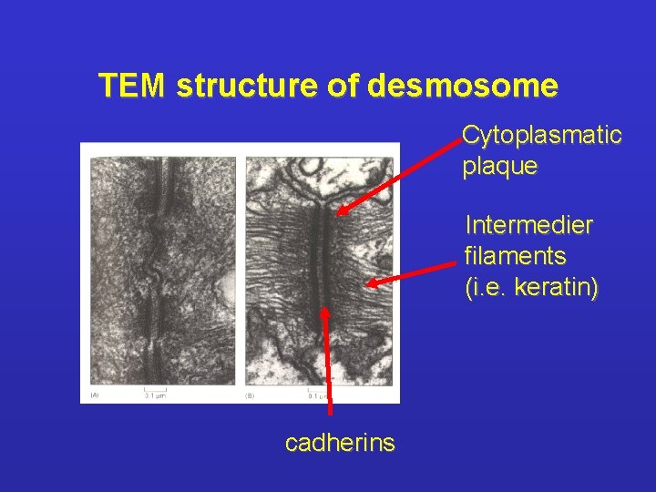 TEM structure of desmosome Cytoplasmatic plaque Intermedier filaments (i. e. keratin) cadherins 