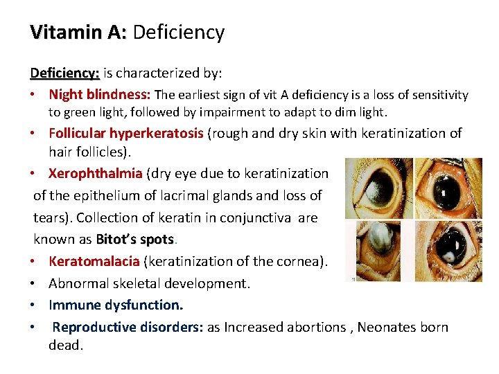 Vitamin A: Deficiency: is characterized by: • Night blindness: The earliest sign of vit