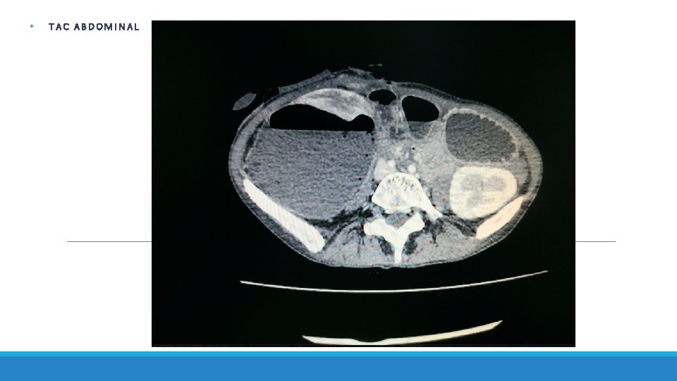  • TAC ABDOMINAL 