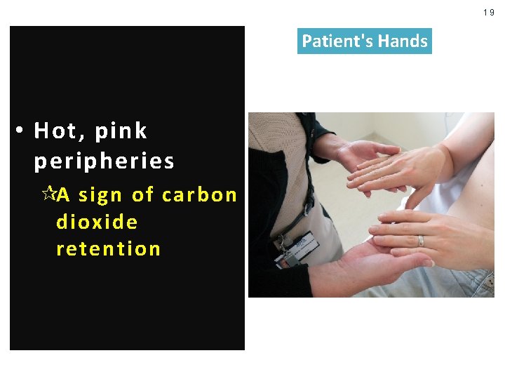 19 Patient's Hands • Hot, pink peripheries ¶A sign of carbon dioxide retention 