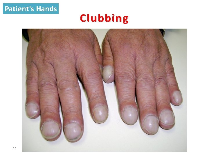 Patient's Hands 20 Clubbing 