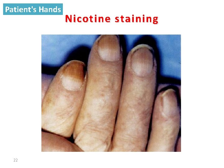 Patient's Hands 22 Nicotine staining 