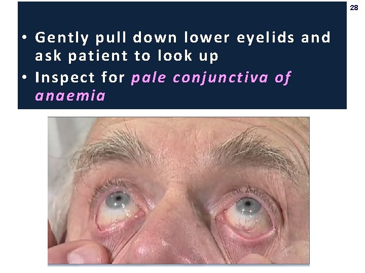 28 • Gently pull down lower eyelids and ask patient to look up •