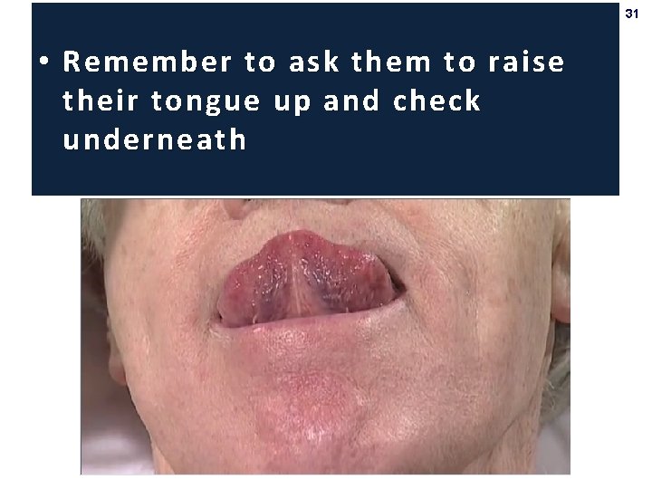 31 • Remember to ask them to raise their tongue up and check underneath