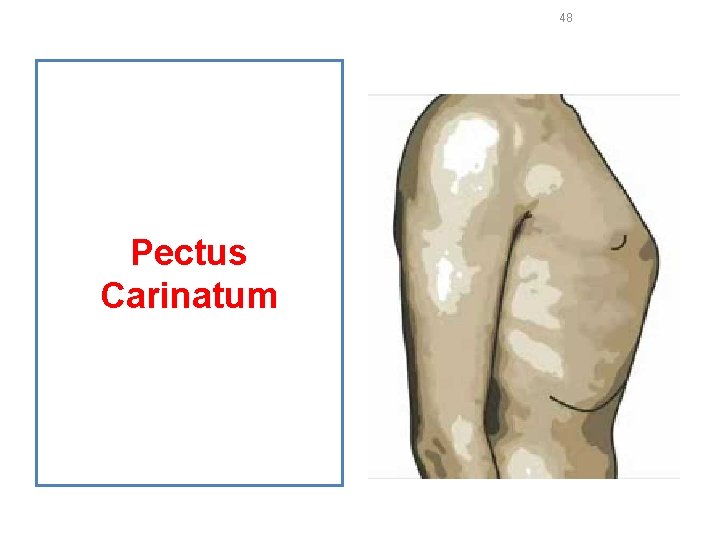 48 Pectus Carinatum 