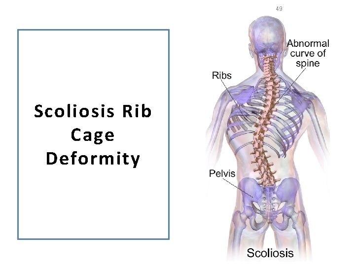 49 Scoliosis Rib Cage Deformity 