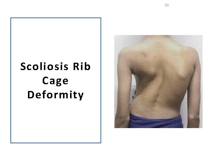 50 Scoliosis Rib Cage Deformity 