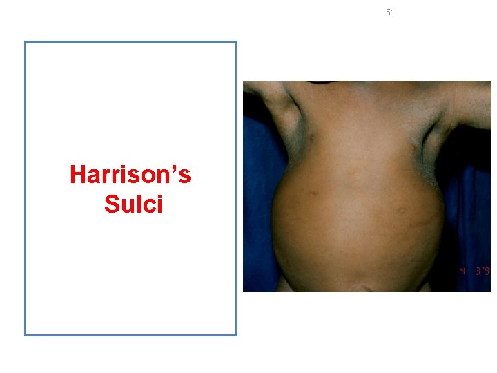 51 Harrison’s Sulci 