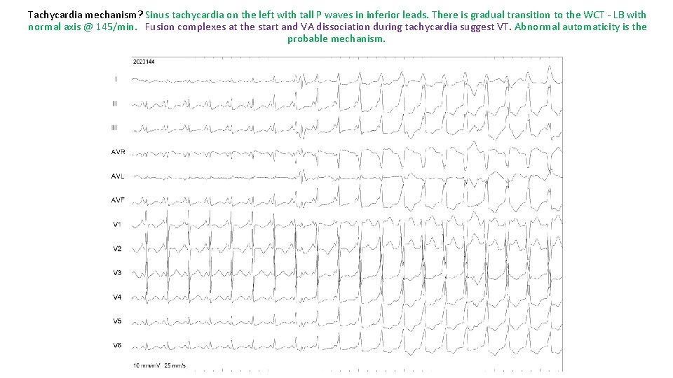 Tachycardia mechanism? Sinus tachycardia on the left with tall P waves in inferior leads.