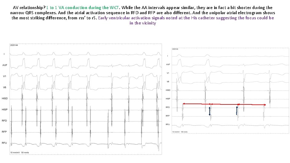AV relationship? 1 to 1 VA conduction during the WCT. While the AA intervals