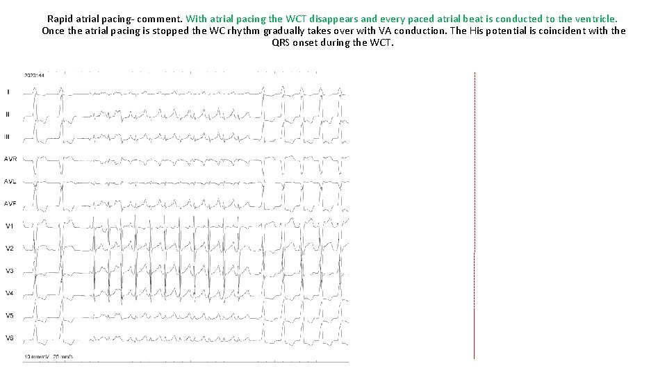 Rapid atrial pacing- comment. With atrial pacing the WCT disappears and every paced atrial