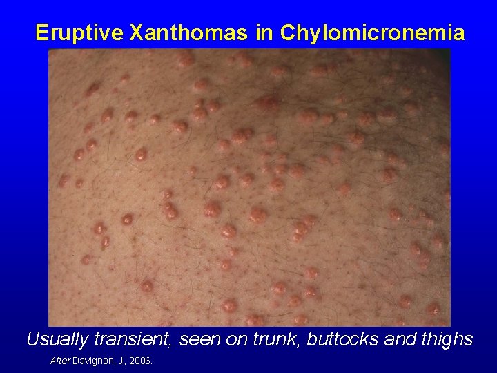 Eruptive Xanthomas in Chylomicronemia Usually transient, seen on trunk, buttocks and thighs After Davignon,