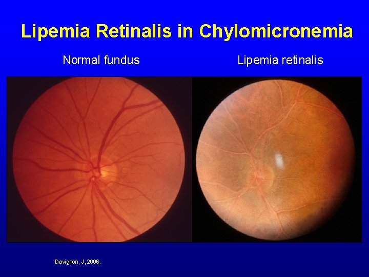 Lipemia Retinalis in Chylomicronemia Normal fundus Davignon, J, 2006. Lipemia retinalis 