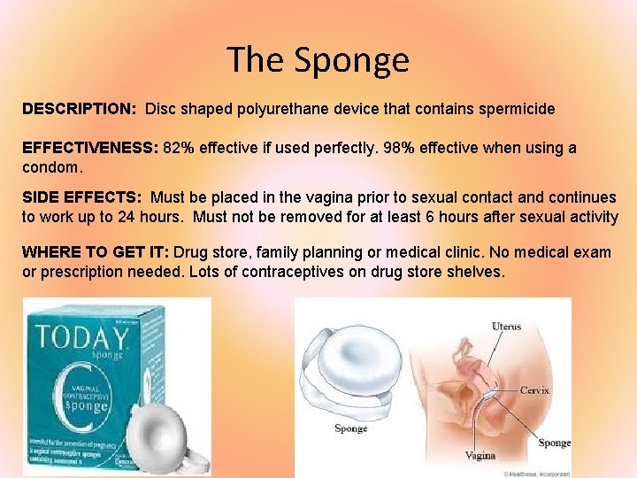 The Sponge DESCRIPTION: Disc shaped polyurethane device that contains spermicide EFFECTIVENESS: 82% effective if