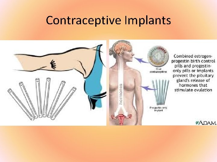Contraceptive Implants 