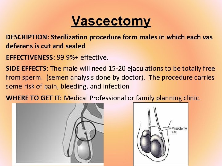 Vascectomy DESCRIPTION: Sterilization procedure form males in which each vas deferens is cut and