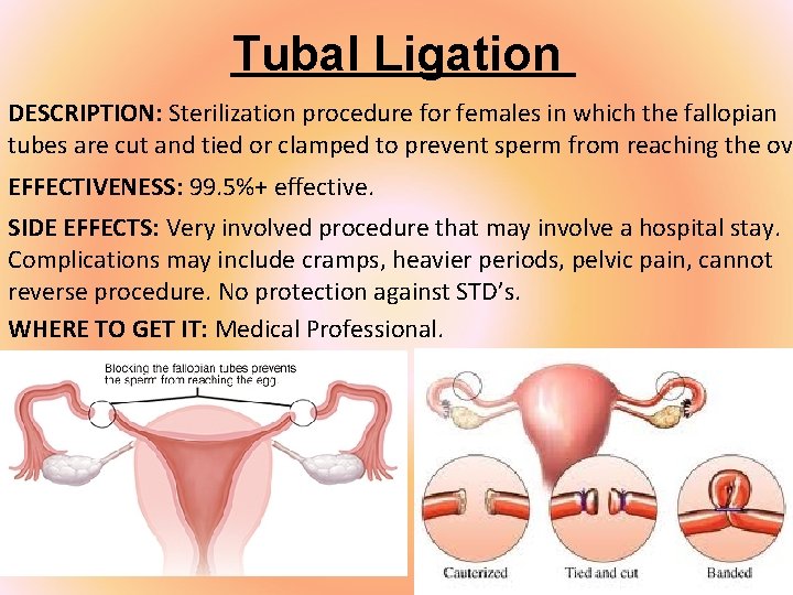 Tubal Ligation DESCRIPTION: Sterilization procedure for females in which the fallopian tubes are cut