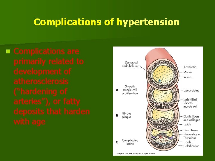 Complications of hypertension n Complications are primarily related to development of atherosclerosis (“hardening of