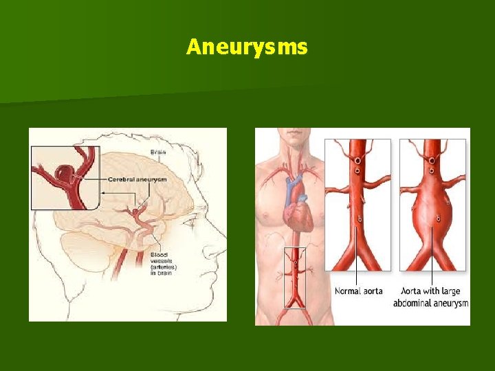 Aneurysms 