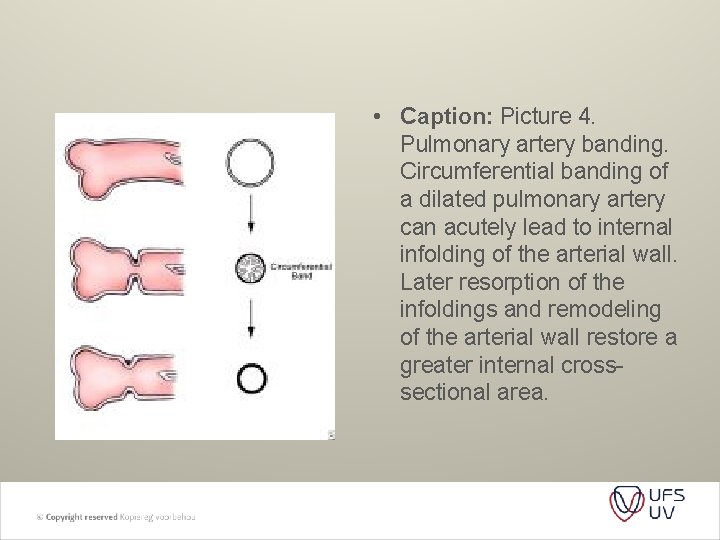 • Caption: Picture 4. Pulmonary artery banding. Circumferential banding of a dilated pulmonary