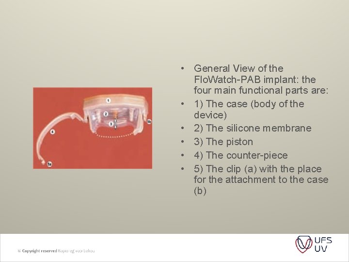 • General View of the Flo. Watch-PAB implant: the four main functional parts