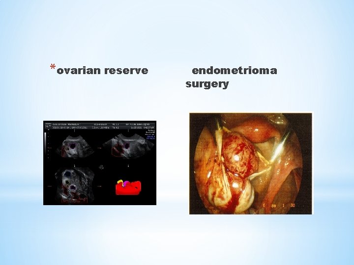 *ovarian reserve endometrioma surgery 