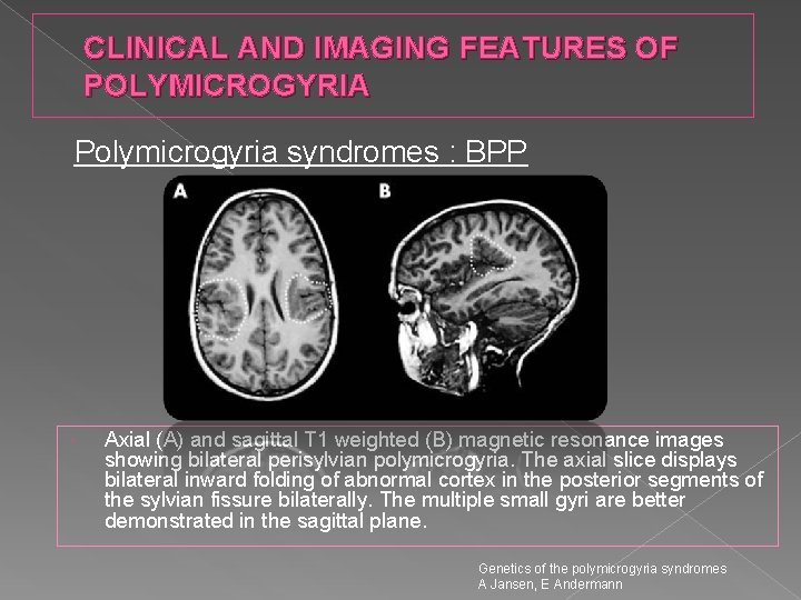 CLINICAL AND IMAGING FEATURES OF POLYMICROGYRIA Polymicrogyria syndromes : BPP Axial (A) and sagittal