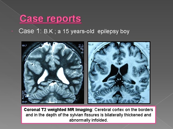Case reports Case 1: B. K ; a 15 years-old epilepsy boy Coronal T