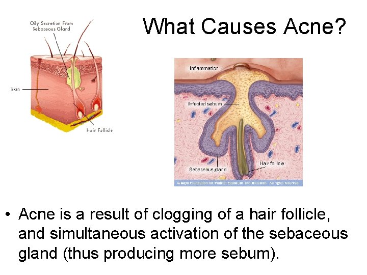 What Causes Acne? • Acne is a result of clogging of a hair follicle,