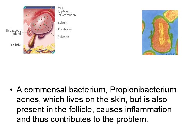  • A commensal bacterium, Propionibacterium acnes, which lives on the skin, but is