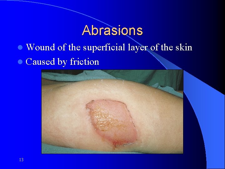Abrasions l Wound of the superficial layer of the skin l Caused by friction