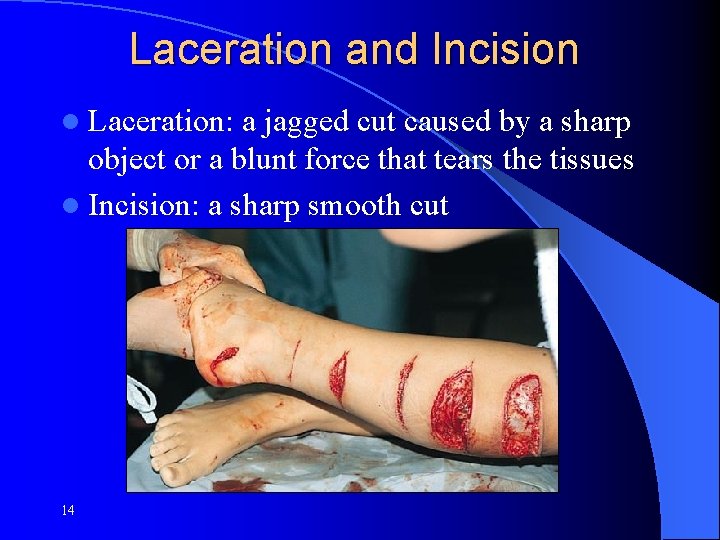 Laceration and Incision l Laceration: a jagged cut caused by a sharp object or