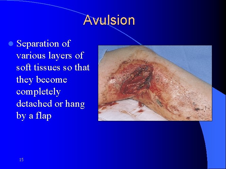 Avulsion l Separation of various layers of soft tissues so that they become completely