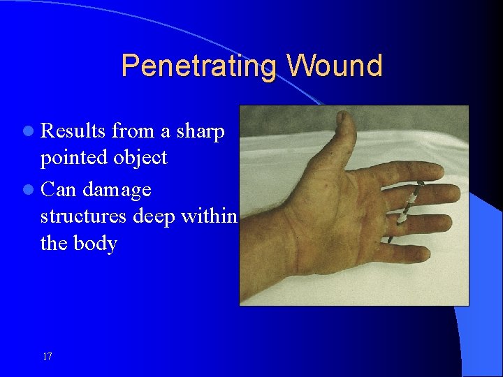 Penetrating Wound l Results from a sharp pointed object l Can damage structures deep